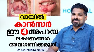 വായിൽ കാൻസർ ഈ 4 രോഗ ലക്ഷണങ്ങൾ അവഗണിക്കരുത്  Oral Cancer  Dr Santhosh Kumar [upl. by Euh]