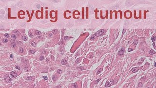 Leydig Cell Tumours of the Testis  Pathology mini tutorial [upl. by Seabury567]