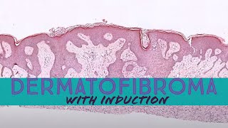 Dermatofibroma with induction phenomenon pathology dermpath dermatology dermatopathology [upl. by Siugram892]