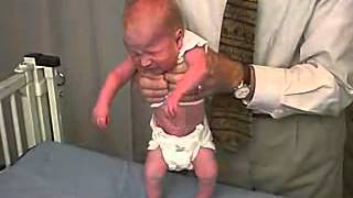 1223 Clinical Pediatrics Hypotonia 6 [upl. by Tnomal]