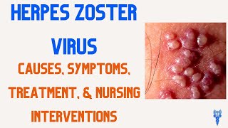 HERPES ZOSTER Symptoms Causes Treatment amp Nursing Interventions [upl. by Luben]