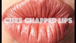 Cure Chapped Lips [upl. by Barb]