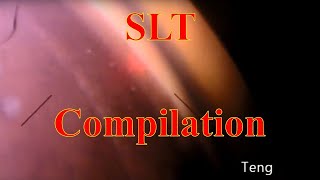 Selective Laser Trabeculoplasty SLT Compilation Chris Teng MD [upl. by Jamie191]