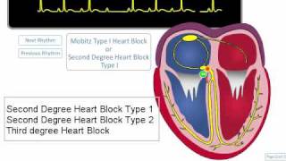 ECG Rhythm Review AV Blocks [upl. by Naujad618]