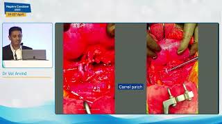 Management of Donor with multiple renal arteries  Dr Vel Arvind [upl. by Haven]