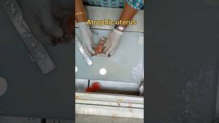 Atrophic uterus specimen அட்ராபிக் கருப்பை  biopsy satisfying pathology histopathology [upl. by Covell10]