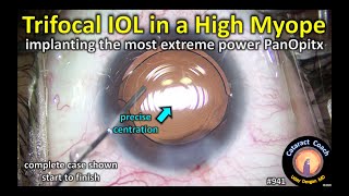 the most extreme Alcon PanOptix IOL power cataract surgery in a highly myopic patient [upl. by Weywadt]