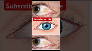 Pinguicula disease in eye medicine drugeducation drugagentmedicalstudent [upl. by Picker]