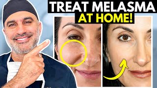 What you NEED to know about treating Melasma AT HOME the RIGHT way [upl. by Layne443]