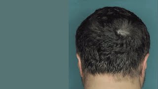 Drug Restores Hair Growth in Patients with Alopecia Areata [upl. by Chick213]