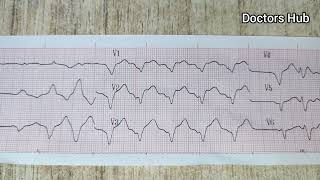 Sine Wave Hyperkalemia on ECG [upl. by Aissila]