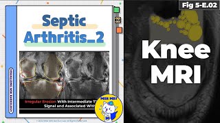 Fig 5E02 Bone Erosions in Pyogenic Arthritis [upl. by Fredella]