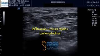 Enfermedad de Ledderhose o Fibromatosis plantar Tratamiento mediante ecografía [upl. by Kendell462]