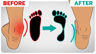 How to Correct Overpronation Fallen Arches [upl. by Litta]