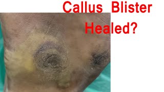 callus infection before after video [upl. by Allenad]