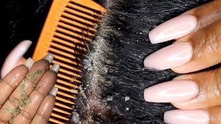 Scalp scratching and picking  Satisfying Dandruff Removal ASMR  Psoriasis [upl. by Eolcin]