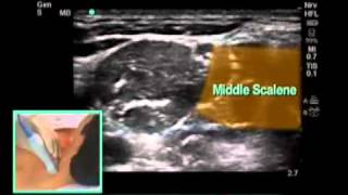 How To UltrasoundGuided Interscalene Block Scanning Technique Video [upl. by Monsour]