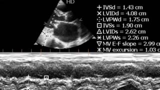 ASARMS RHD ECHOCARDIOGRAPHY SERIES BY DRANKUR KCHAUDHARI [upl. by Melborn228]