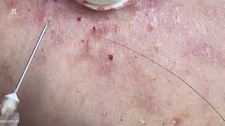 Big Cystic Acne Blackheads Extraction Blackheads amp Milia Whiteheads Removal Pimple Popping [upl. by Bowrah746]