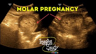 Molar Pregnancy  Hydatidiform Mole  Gestational Trophoblastic Disease  Ultrasound  Case 38 [upl. by Elisabet176]