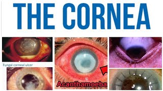 Cornea 6 Major TopicAcanthamoeba Keratitis [upl. by Boelter]