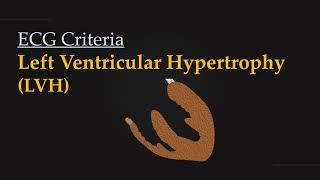 ECG Criteria for Left Ventricular Hypertrophy LVH [upl. by Luapnaej903]