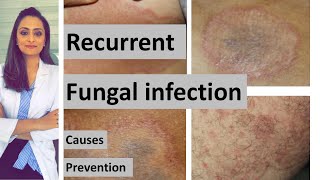 Recurrent fungal infection  causes How to prevent [upl. by Phylys954]