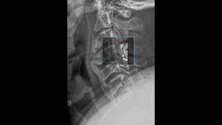 Diffuse Idiopathic Skeletal Hyperostosis DISH [upl. by Maurilla]