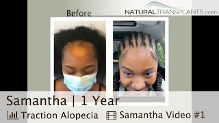 Hair Transplant After One Year For Traction Alopecia Patient  Dr Blumenthal Samantha [upl. by Nie275]