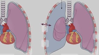 Emergencias Neumológicas Neumotórax [upl. by Onaivlis914]