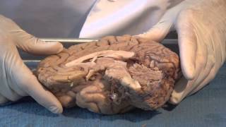 The Ventricles Neuroanatomy Video Lab  Brain Dissections [upl. by Bern]