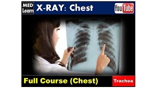 X RAY Chest 2 Trachea cme internalmedicine medicalstudent usmle محاضراتباطنة [upl. by Oizirbaf742]