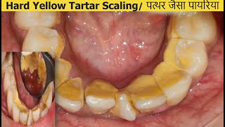 Dental CleaningScaling of Tartar  Irregular teeth  More Chances of Tartar Deposits Dr Ram MDS [upl. by Assilav]