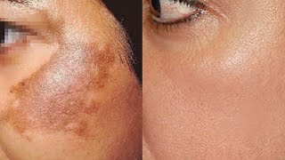 How To Use Potato To Treat Skin Pigmentation Dark Spots Acne Scars Easily At Home  Home Remedies [upl. by Ahsikyw]