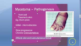 Microbiology 578 a Mycetoma foot Madurella mycetomatis Maduramycosis mycosis Eumycetoma Welsh regime [upl. by Ryann]