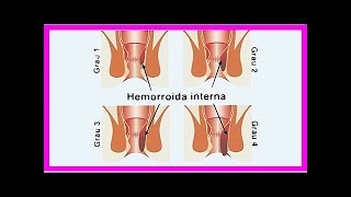 Erfahren Sie wie Hämorrhoiden zu beseitigen um den Schmerz zu beenden [upl. by Asiil44]