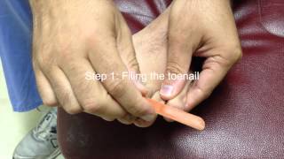 3 Simple tricks to help clear fungal toenails [upl. by Acirtap]