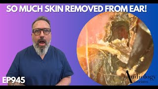 SO MUCH SKIN REMOVED FROM PATIENTS EAR CANAL  EP945 [upl. by Nemraciram4]