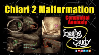 Chiari 2 Malformation  Ultrasound  Anomaly  Case 287 [upl. by Yeniar971]