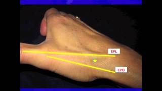 Thumb CarpalMetacarpal CMC Joint injection [upl. by Laird]