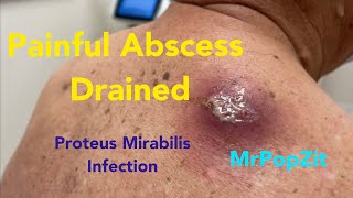 Painful large abscess infected with Proteus Mirabilis drainedCyst contents start at 1410 Amazing [upl. by Olnton]