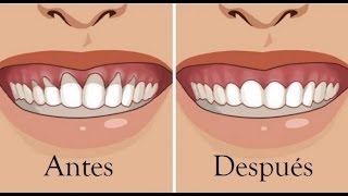 Retracción de encías remedios caseros para arreglarlas [upl. by Roselia]