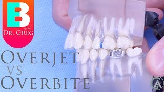 Braces time lapseoverbite and overjet correction braces before after [upl. by Latreshia]