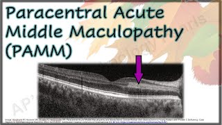 Paracentral Acute Middle Maculopathy PAMM [upl. by Firahs]