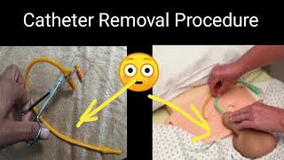 How To Remove Catheter With Scissors  Catheter Removal Procedure  How to Cut Catheter [upl. by Ikcir]