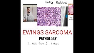 Bone tumor Pathology Ewing Sarcoma [upl. by Abroms679]