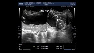 Ultrasound Video showing Anencephaly with a pregnancy of about 17 weeks [upl. by Neltiac758]