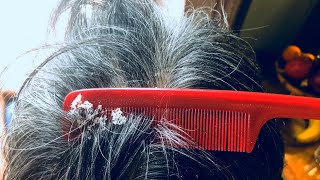 Dandruff build up  Scraping with comb [upl. by Naam]