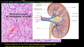 90P Morphology of Systemic lupus erythematosus SLE part 1 [upl. by Fitzpatrick]