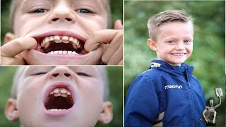 Shark boyMeet schoolboy nicknamed Jaws with TWO sets of teeth [upl. by Moffit]